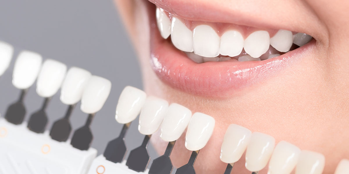 Dantų balinimas: būdai ir priemonės, kad jūsų dantys išliktų balti