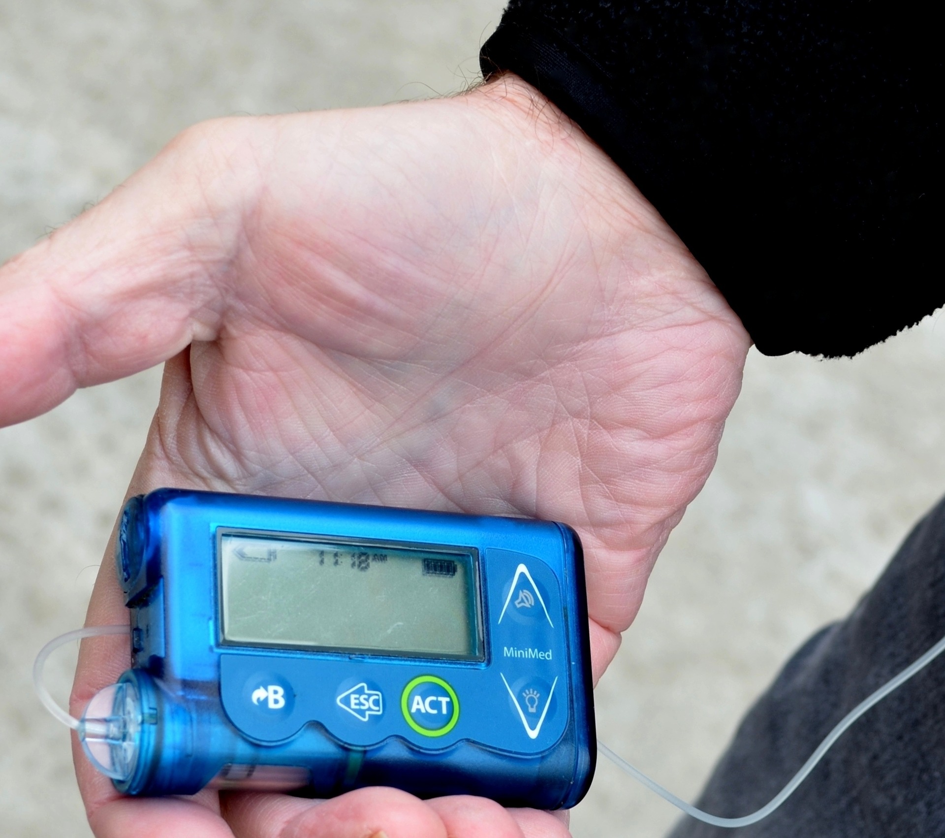 SAM: insulino pompos bus prieinamos visiems sergantiesiems I tipo cukriniu diabetu